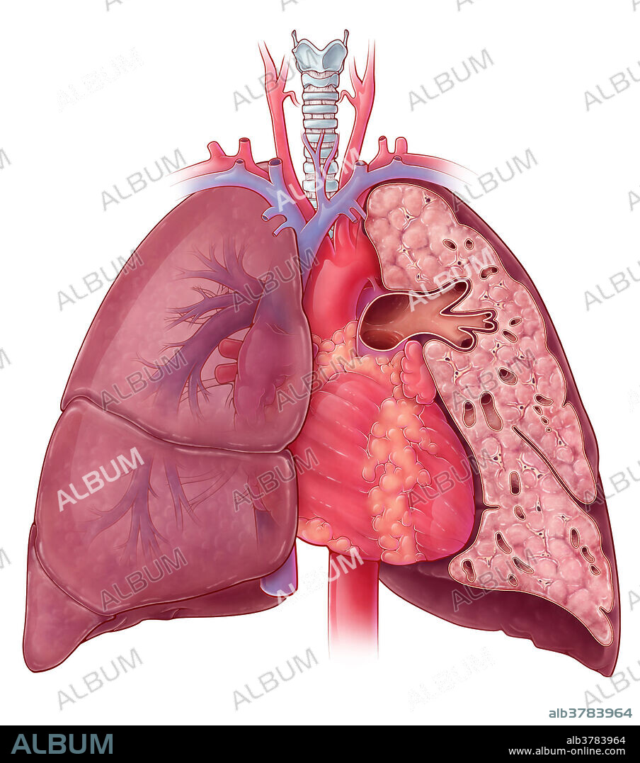 An illustration of the heart and lungs, with a cross-sectional view of the left lung showcasing branches of the left pulmonary arteries.