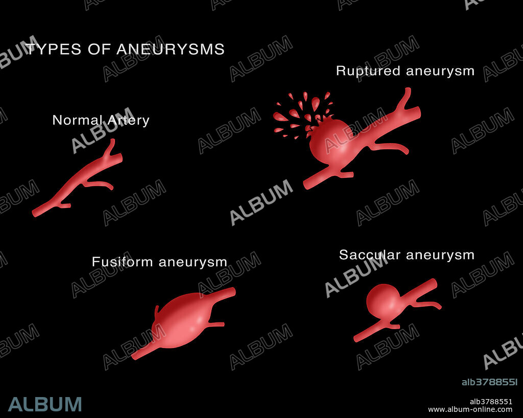 Types of Aneurysms