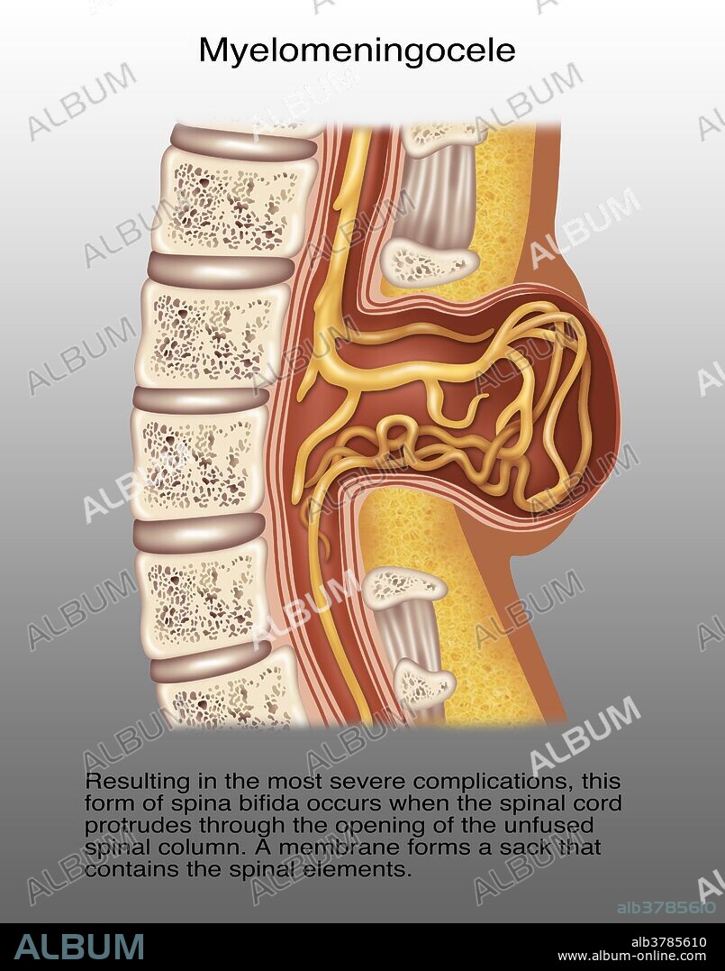 Illustration of spina myelomeningocele. Resulting in the most severe complications, this form of spina bifida occurs when the spinal cord protrudes through the opening of the unfused spinal column . A membrane forms a sack that contains the spinal elements.