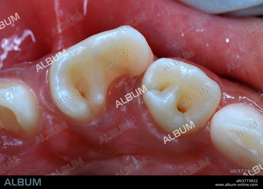 Dens in Dente Malformation of teeth #s 7, 9, and 10 (maxillary right and left lateral incisors, and maxillary left central incisor). Dens in Dente ( tooth within a tooth ), also known as Dens invaginatus, is where the outer surface of the tooth folds inward. Image before restorative procedures.