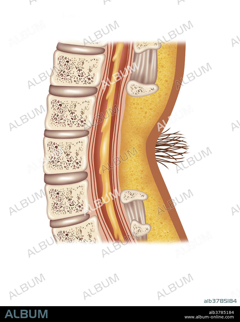 Illustration of spina bifida occulta. Spina bifida occulta is the mildest form of spina bifida in which the outer layer part of vertebrae is not completely closed. The skin may have a dimple or hair growth at the lesion site.