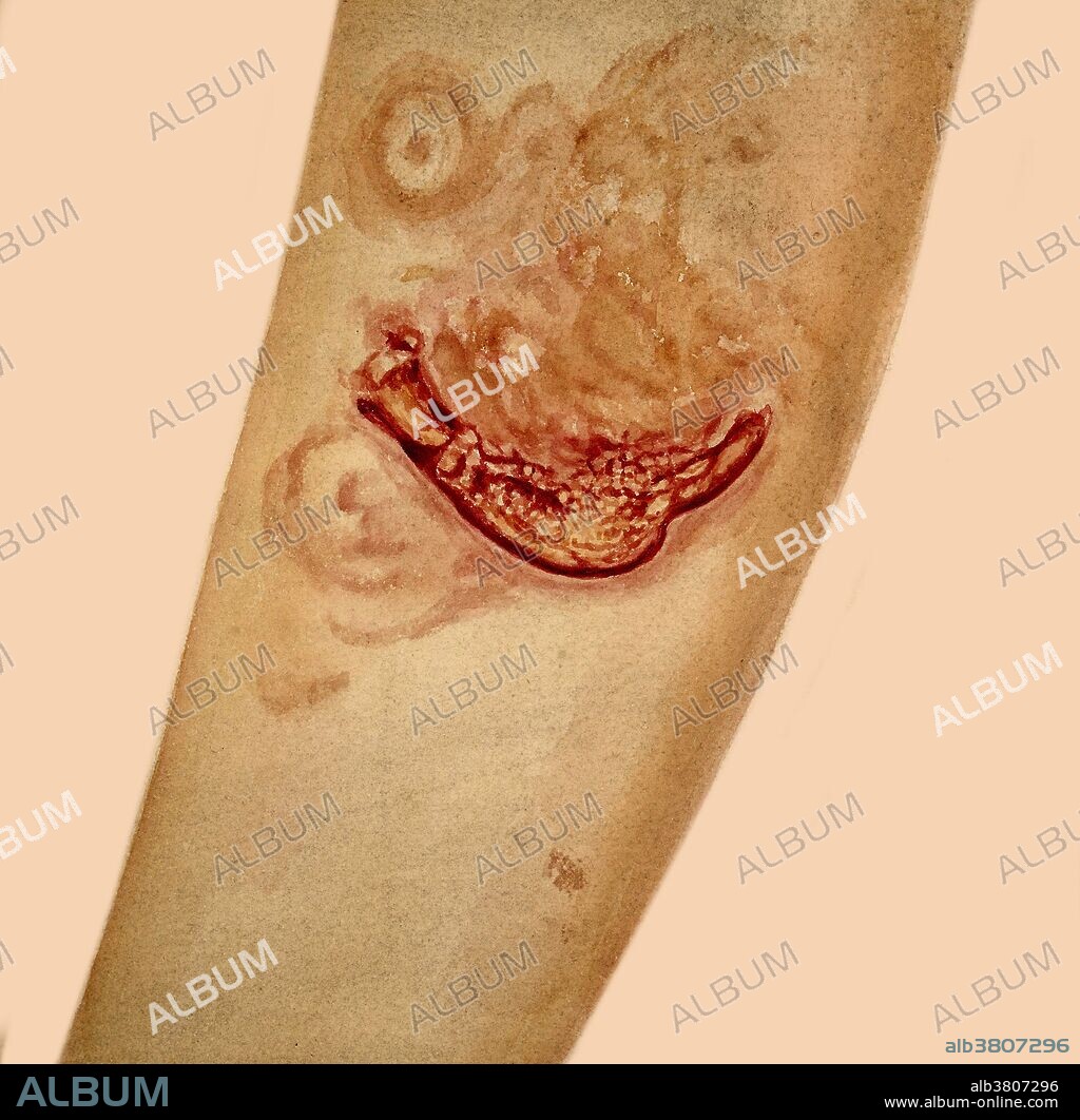 Watercolor drawing illustrating the condition of the skin in a patient who suffered from mycosis fungoides, also known as granuloma fungoides or Alibert-Bazin syndrome. It is the most common form of cutaneous T-cell lymphoma. It generally affects the skin, but may progress internally over time. Symptoms include rash, tumors, skin lesions, and itchy skin. This drawing shows a spreading ulcer on the patient's leg, commencing at the edges of skin sloughs caused by the condition. Leonard Mark, 1894.