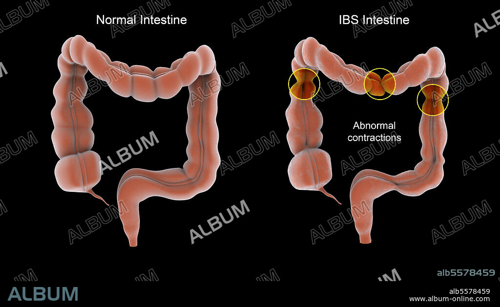 Medical illustration showing normal vs. abnormal contractions associated with irritable bowel syndrome in the human intestines.