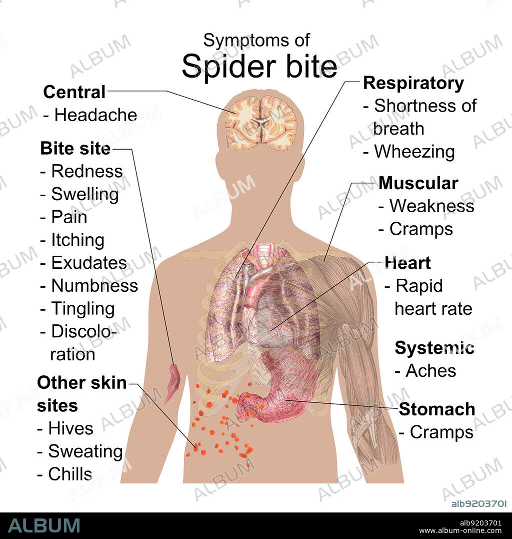 Symptoms most common in all types of poisonous spider bites. The bite site composition in the picture is exampled from a white-tailed spider bite.
