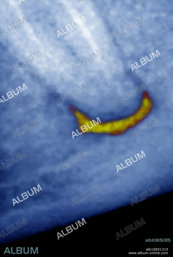 Dental abscess under a molar root canal. Visualization by sagittal dental radiography.