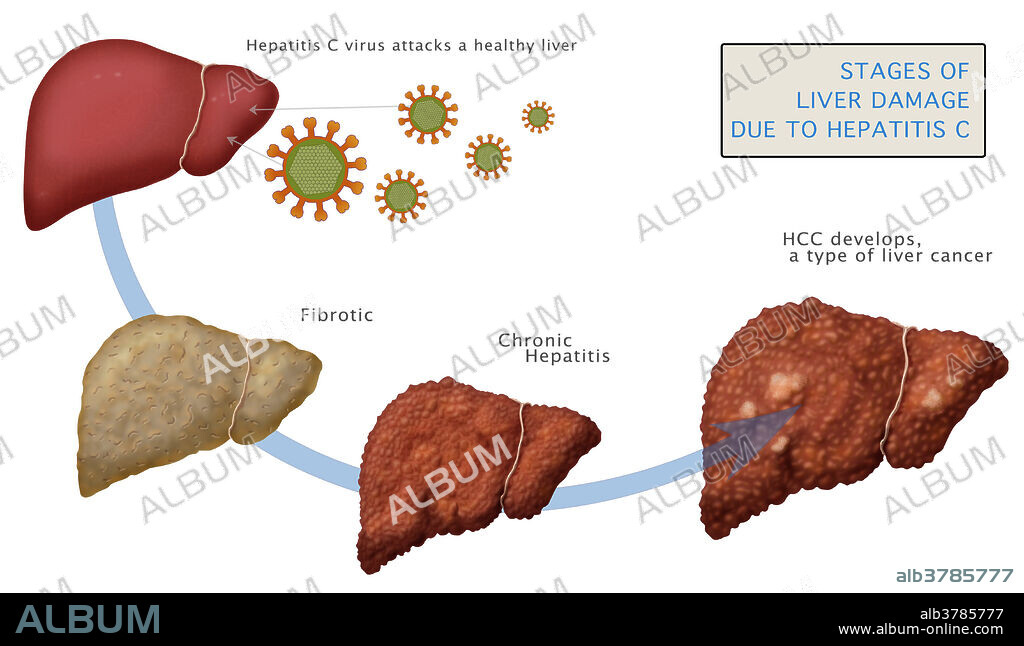 Diagram showing stages of liver damage due to cirrhosis caused by chronic hepatitis C. Cirrhosis is characterized by replacement of liver tissue by fibrosis, scar tissue and regenerative nodules (lumps that occur as a result of a process in which damaged tissue is regenerated), leading to loss of liver function.
