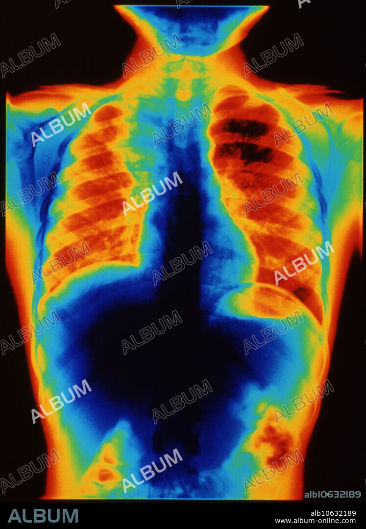 Lobar pneumonia. Coloured chest X-ray showing lobar pneumonia in the upper lobe of a 7 year old girl's lung. The affected area appears pale blue in the top of the red lung at upper left. Lobar pneumonia is caused by certain strains of Strepto- coccus pneumoniae bacteria and usually affects a single lobe of one of the lungs. Alveoli (air sacs) in the lobe become blocked with pus, preventing air flow and causing affected tissue to solidify. Symptoms include fever, painful breathing and a cough that produces rust-coloured sputum. In most cases antibiotic drugs help the patient to make a full recovery, but the disease can be fatal in the elderly or debilitated.