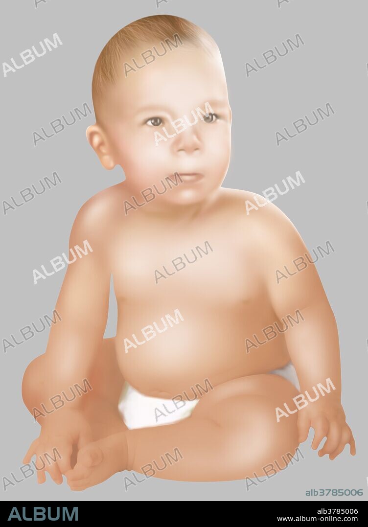Illustration of baby with Fetal Alcohol Syndrome. Fetal Alcohol Syndrome or (FAS) is a condition in infants that is caused by alcohol consumption by the mother during time of pregnancy. Mental and physical defects such as a small head, flat face, epicanthal folds, smooth philtrum, thin upper lip, small eye openings, short nose, low nasal bridge, and underdeveloped jaw, are common symptoms of fetal exposure to alcohol.