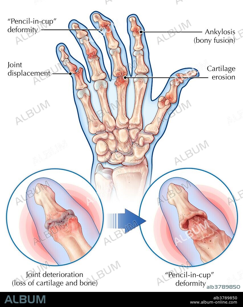 An illustration of joints affected by psoriatic arthritis, a chronic inflammatory skin condition (psoriasis) accompanied by arthritis and other joint problems. A "pencil-in-cup" deformity is a typical characteristic of psoriatic arthritis as bone begins wearing away due to prolonged damage. Other symptoms such as cartilage erosion, joint fusions or joint displacements may also occur.