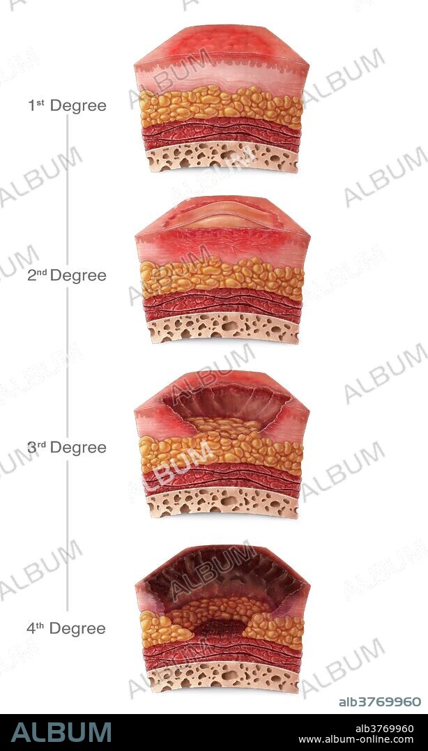 A diagram of illustrated sections of skin with different burn degrees. First degree burns (top) only affect the epidermis, the superficial layer of skin, and are commonly caused by sunburns. Second degree burns extend to deep portions of the dermis and are accompanied by the formation of blisters. Third and fourth degree burns extend beyond the epidermis and dermis to underlying layers of fat, muscle or bone, and require excision or amputation of affected regions.