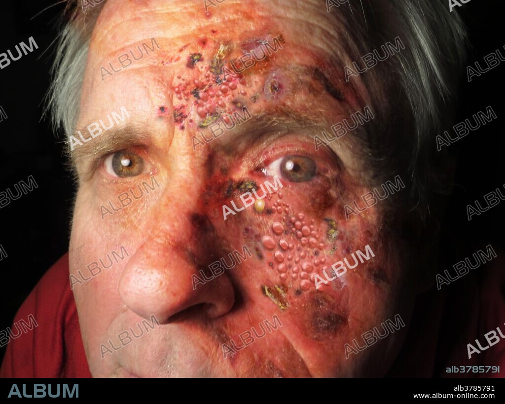 Composite image of a man with shingles near his eye. Shingles (Herpes zoster) is a painful, blistering skin rash due to the varicella-zoster virus, the virus that causes chickenpox.