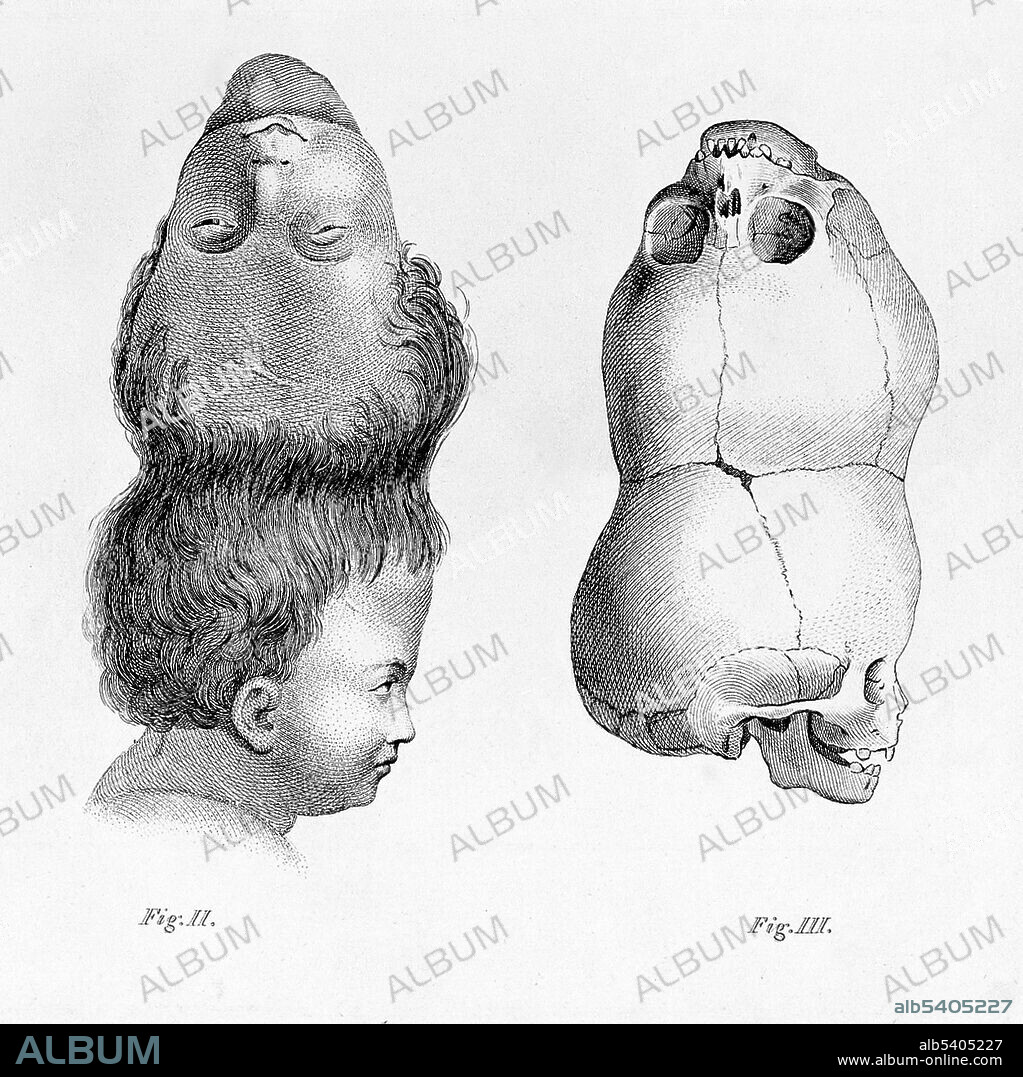 The so-called "Two-Headed Boy of Bengal" was born in 1783 and died of a cobra bite in 1787. His skull remains in the collection of the Hunterian Museum of the Royal College of Surgeons of London. Craniopagus parasiticus is an extremely rare type of parasitic twinning occurring in about 4 to 6 of 10,000,000 births. In craniopagus parasiticus, a parasitic twin head with an undeveloped body is attached to the head of a developed twin. Fewer than a dozen cases of this type of conjoined twin have been documented in history Most infants with this condition are stillborn, or die shortly after birth. Only ten cases of craniopagus parasiticus have been reported in the medical research literature. Of those cases, only three have survived birth.