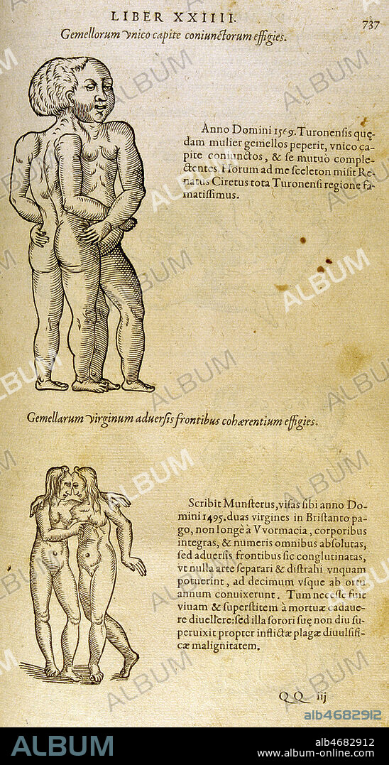 TERATOLOGIE: Monstre a deux corps et une seule tete. Soeurs siamoises attachees par le front. Illustration tiree d'un ouvrage d'Ambroise PARE (1509-1590) datant de 1582 (16e, 16eme, XVIe s.). Credit : Collection JEAN VIGNE / KHARBINE-TAPABOR.