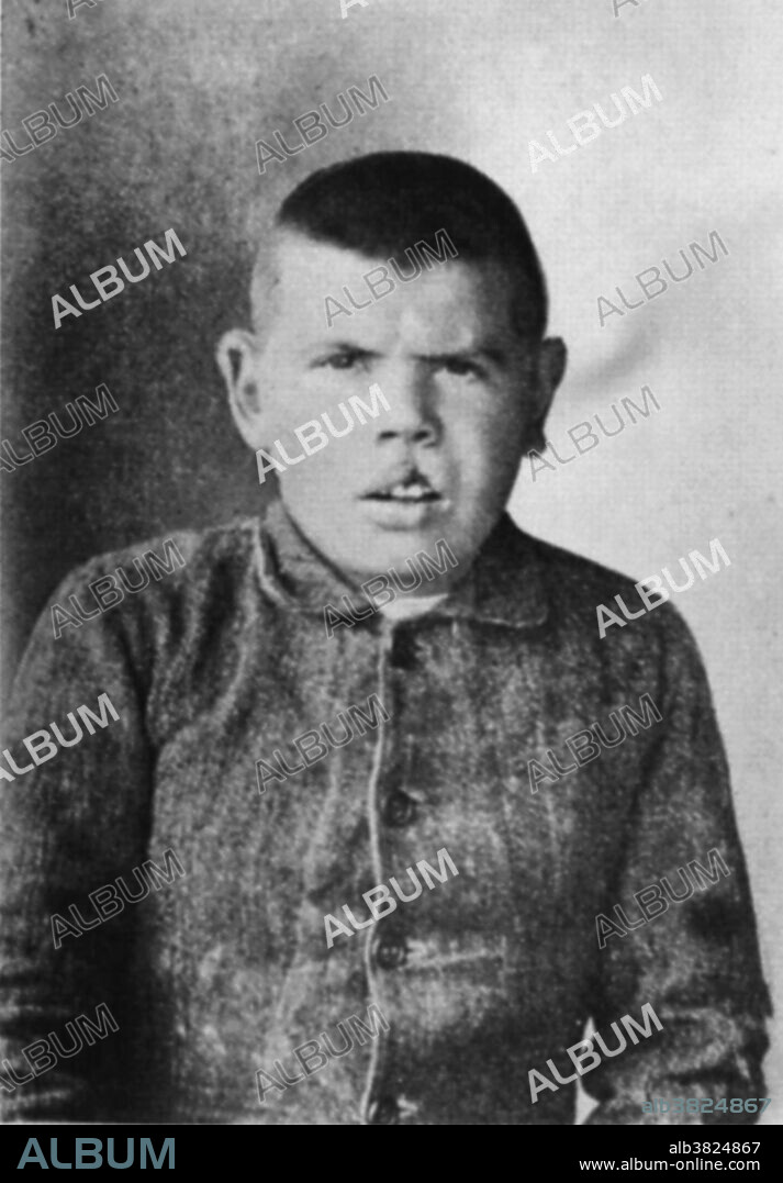 A patient treated by Cesare Lombroso. Lombroso was a nineteenth century Italian criminologist who believed that a person's criminal tendencies were directly tied to physical deformities.