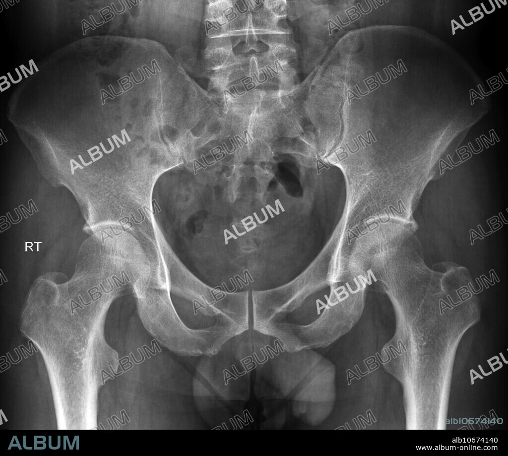 Normal X-ray of pelvis in a 35 year old male.