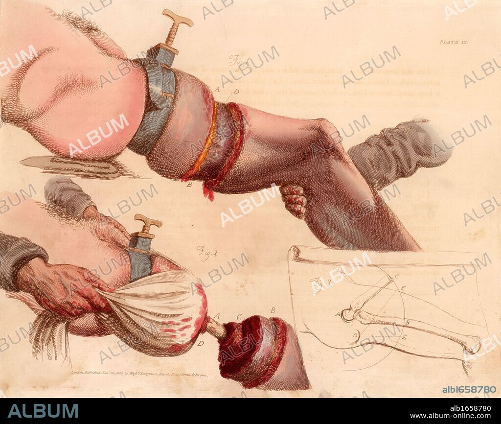 Amputation of the leg at the thigh. The tourniquet deadened the pain as well as reducing the flow of blood but was likely to cause serious tissue damage.  From "Illustrations of the Great Operations of Surgery" by Charles Bell (London, 1821). Hand-coloured engraving. (Photo by: Universal History Archive/UIG via Getty Images).