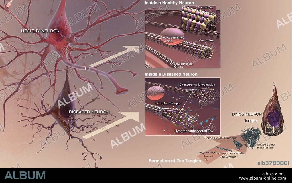 Neurofibrillary Tangles (NFTs) are aggregates of hyperphosphorylated tau protein that are most commonly known as a primary marker of Alzheimer's disease. Alzheimer's disease (AD), also known as Alzheimer disease, or just Alzheimer's, accounts for 60% to 70% of cases of dementia. It is a chronic neurodegenerative disease that usually starts slowly and gets worse over time. The most common early symptom is difficulty in remembering recent events (short-term memory loss). As the disease advances, symptoms can include problems with language, disorientation (including easily getting lost), mood swings, loss of motivation, not managing self care, and behavioral issues. As a person's condition declines, they often withdraw from family and society. Gradually, bodily functions are lost, ultimately leading to death. Although the speed of progression can vary, the average life expectancy following diagnosis is three to nine years. About 70% of the risk is believed to be genetic with many genes usually involved.