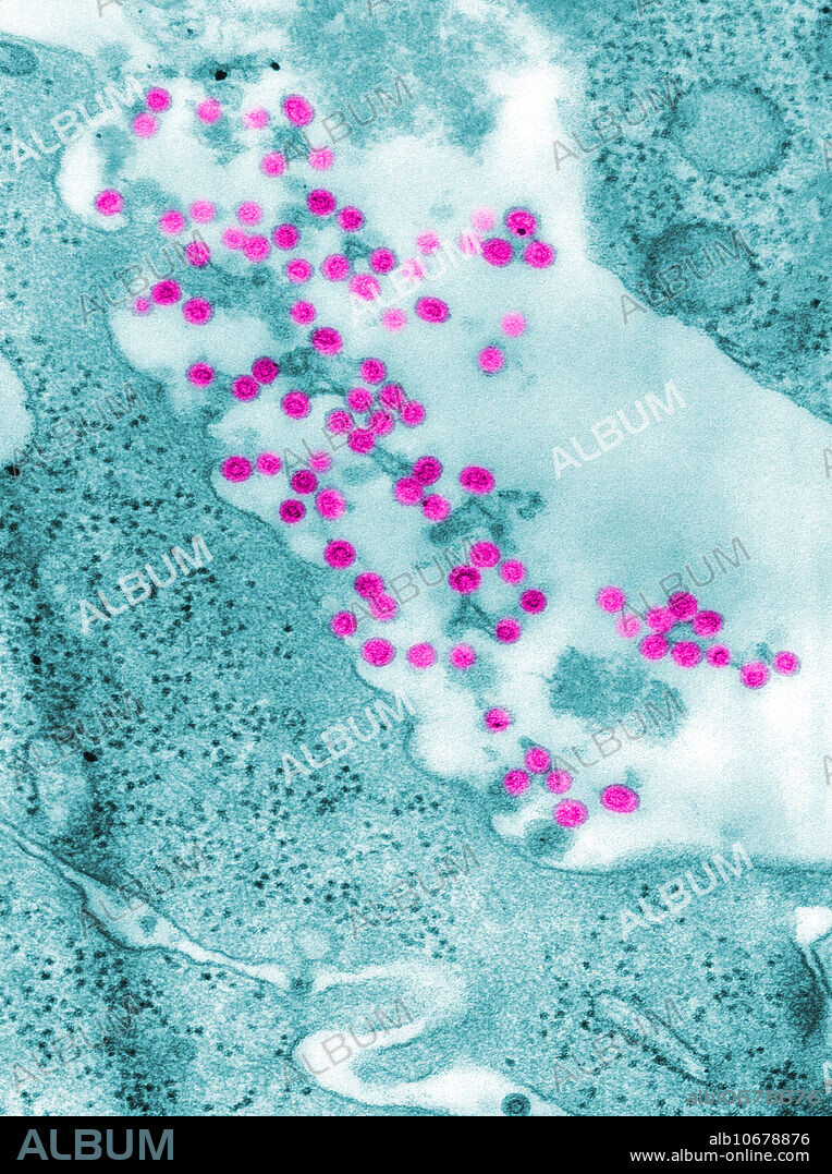 Negatively-stained transmission electron micrograph (TEM) of Rubella virus virions (purple) budding from the host cell surface. This process produces an enveloped virus particle, which means that after budding, the spherical virions' icosahedral capsid is enclosed in the host cell membrane. Inside the capsid lies the Rubella virus' positive-sense single-stranded RNA (( )ssRNA) genome. The Rubella virus is known to be the cause of rubella, otherwise known as German measles. Rubella, also known as German measles or 3-day measles, is a respiratory viral infection characterized by mild respiratory symptoms and low-grade fever, followed by a maculopapular rash lasting about 3 days.