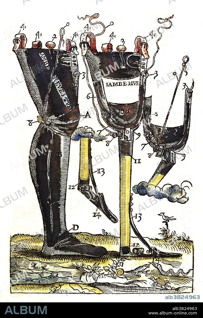 Metal artificial legs designed by Ambroise Pare, 1564. Pare (1510-1590) was a French surgeon, anatomist and inventor. He was royal surgeon for kings Henry II, Francis II, Charles IX and Henry III and is considered one of the fathers of surgery and modern forensic pathology. He was a leader in surgical techniques and pioneered modern battlefield wound treatment. Battlefield medicine is the treatment of wounded soldiers in or near an area of combat. Pare introduced the ligature of arteries instead of cauterization during amputation. He believed that phantom pains occurred in the brain. He contributed to the practice of surgical amputation and the design of limb prostheses.