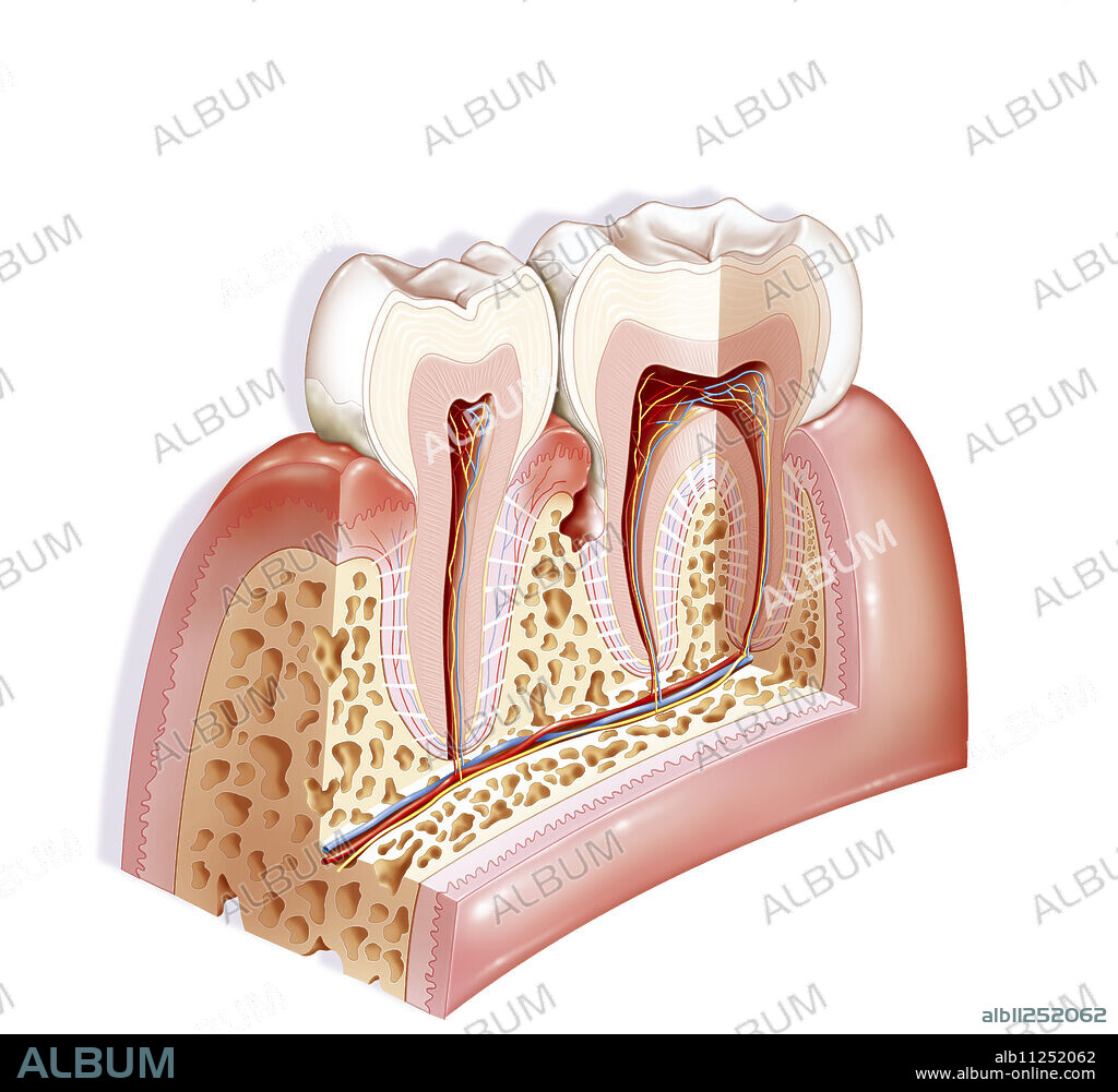 Periodontitis is an inflammation of the periodontium. The periodontium consists of the supporting tissues of the dental organ: the gum, the cementum, the alveolar-dental ligament and the alveolar bone. It is the evolution of gingivitis (inflammation and swelling of the gum visible on the left of this drawing) which has spread to the underlying tissues. Periodontitis is formed by a periodontal pocket associated with a loss of attachment of the tooth with the support tissues that can be seen particularly in this drawing with damage to the alveolar bone.