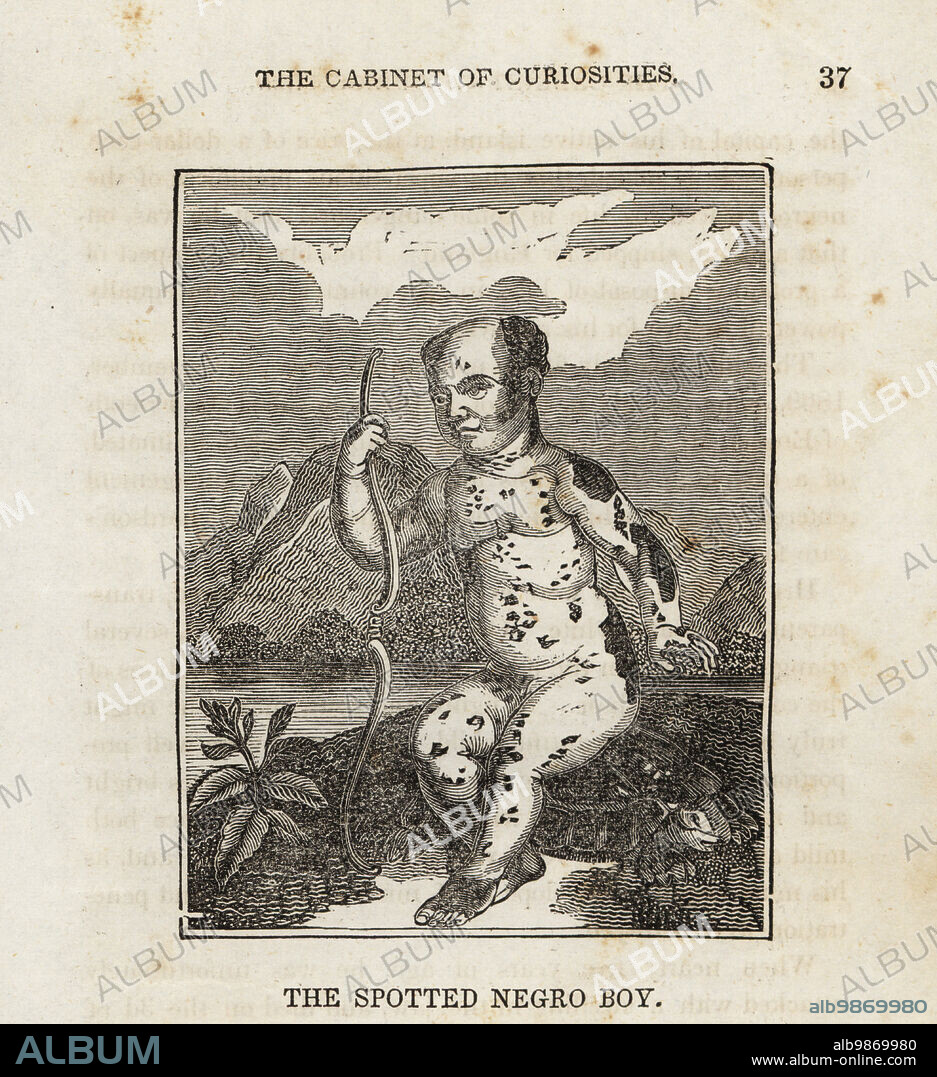 George Alexander Gratton, 1808-1813, exhibited in England as the Spotted Negro Boy. Boy with vitiligo born on St. Vincent to enslaved African parents.Woodcut after Daniel Orne from The Cabinet of Curiosities, or Wonders of the World Displayed, Henry Piercy, New York, 1836.