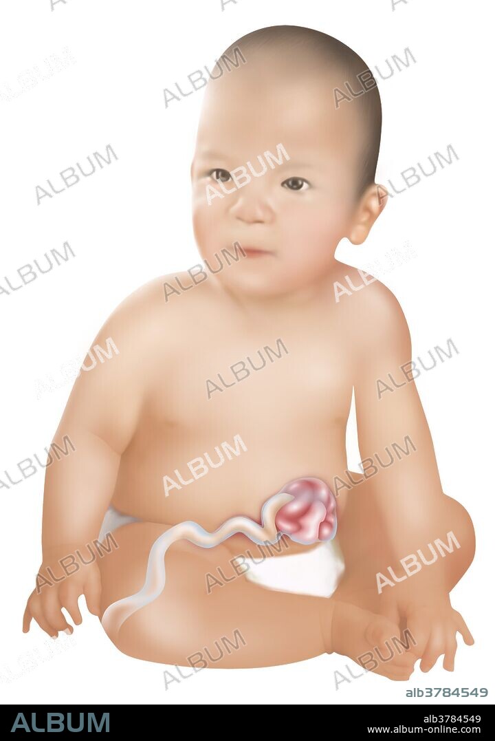 An illustration of a baby with Gastroschisis. Gastroschisis is a congenital defect in the anterior abdominal wall which allows for the contents of the digestive system to protrude. 1 baby in 30 is born with one or more major birth defects. Most are correctable with modern surgery.