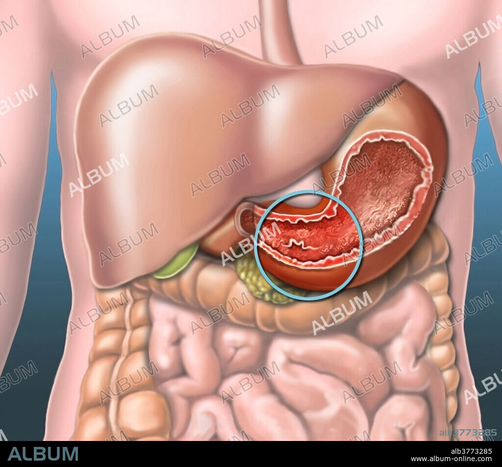 Stomach ulcer, illustration