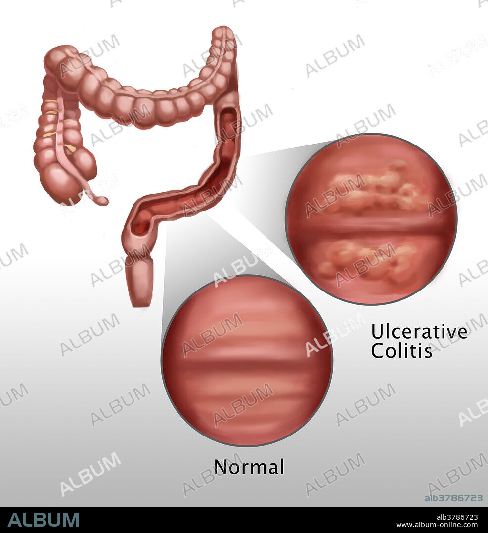 Illustration showing effects of ulcerative colitis on intestinal walls. Ulcerative colitis is an inflammatory bowel disease affecting the inner lining of the large intestine. The disease is characterized by the development of ulcers which begin damaging the mucosal lining, causing inflammation and progressive loss of blood. Severe cases may progress into the growth of pseudopolyps, and patients become more at risk of developing colorectal cancer.