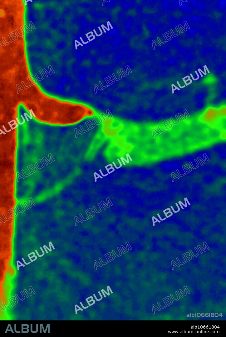 Stenosis (infarct) in the left renal artery, as shown by an abdominal angiography in the frontal position.