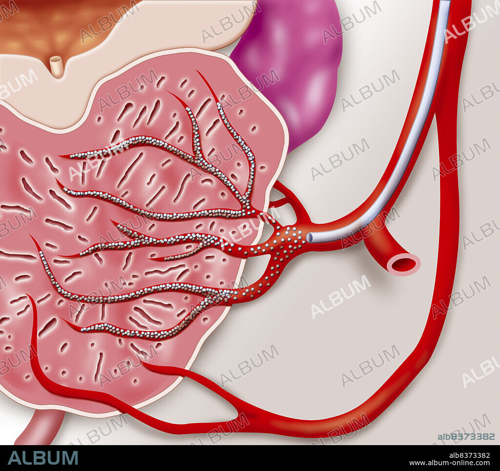 Illustration of prostatic artery embolization, a technique for treating benign prostatic hypertrophy (adenoma of the prostate). While a urinary probe is inserted through the urethra in order to visualise the centre of the prostate, a catheter is introduced through the right femoral artery, up into the common iliac artery, then down the left side via the left, internal iliac artery, the left, internal pudendal artery to reach the prostatic arteries. Micro beads are injected into the prostatic arterioles to the centre of the prostate in order to block the arterioles. The size of the prostate slowly decreases.