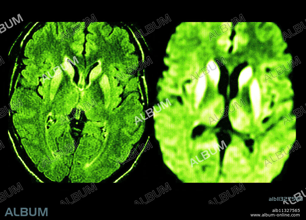 Bilateral lesions of the caudate heads, the putamens, and the internal posterior region of the two thalami (image on the right).