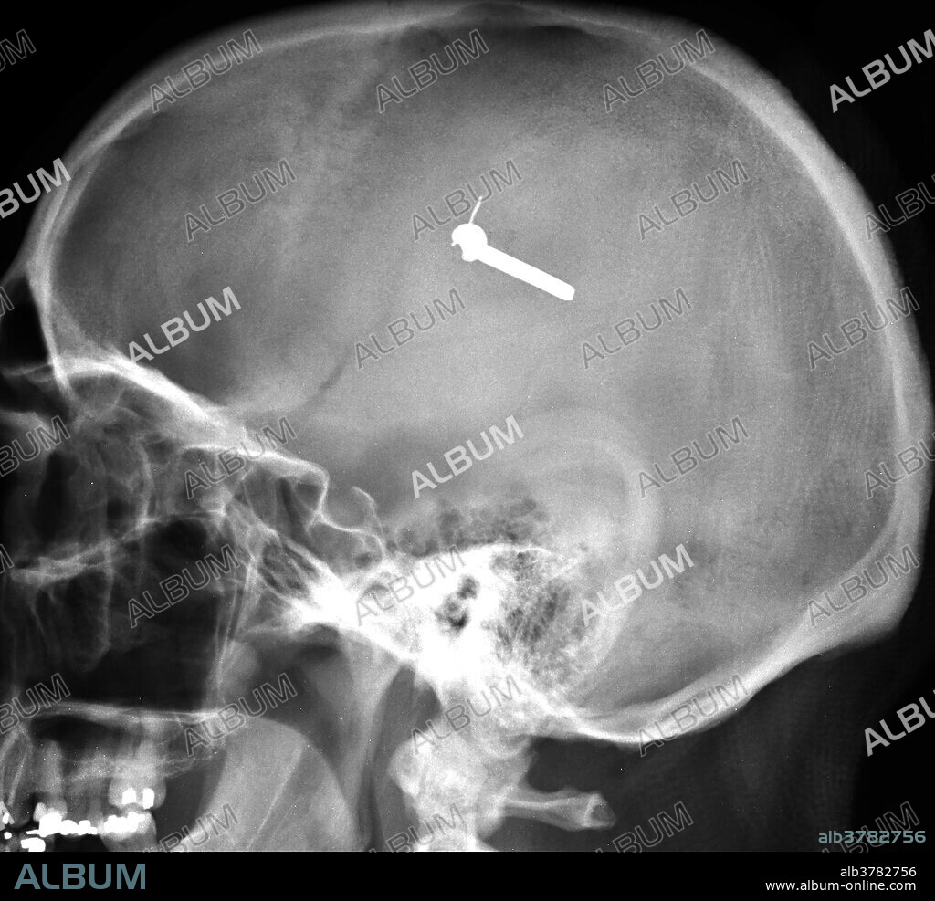 This lateral (from the side) view X-ray of the skull shows a nail which was hammered into the brain through the skull. This is confirmed on the frontal view.