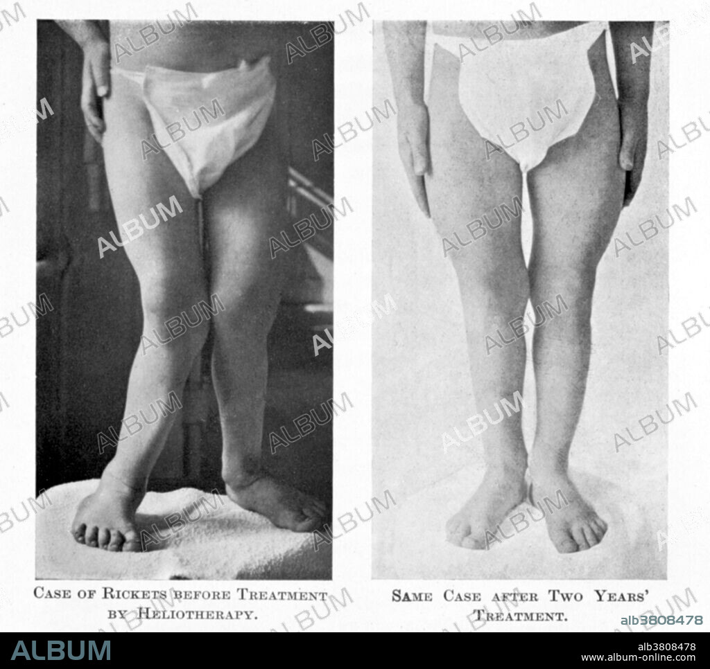 Before and after photographs of a child's legs with rickets treated with heliotherapy for two years. Light therapy or phototherapy, classically referred to as heliotherapy consists of exposure to daylight or to specific wavelengths of light using polychromatic polarized light, lasers, light-emitting diodes, fluorescent lamps, dichroic lamps or very bright, full-spectrum light. The light is administered for a prescribed amount of time and, in some cases, at a specific time of day. Rickets is among the most frequent childhood diseases in many developing countries. The predominant cause is a vitamin D deficiency, but lack of adequate calcium in the diet may also lead to rickets. A sufficient amount of ultraviolet B light in sunlight each day and adequate supplies of calcium and phosphorus in the diet can prevent rickets. Darker-skinned people need to be exposed longer to the ultraviolet rays. The replacement of vitamin D has been proven to correct rickets using these methods of ultraviolet light therapy and medicine.