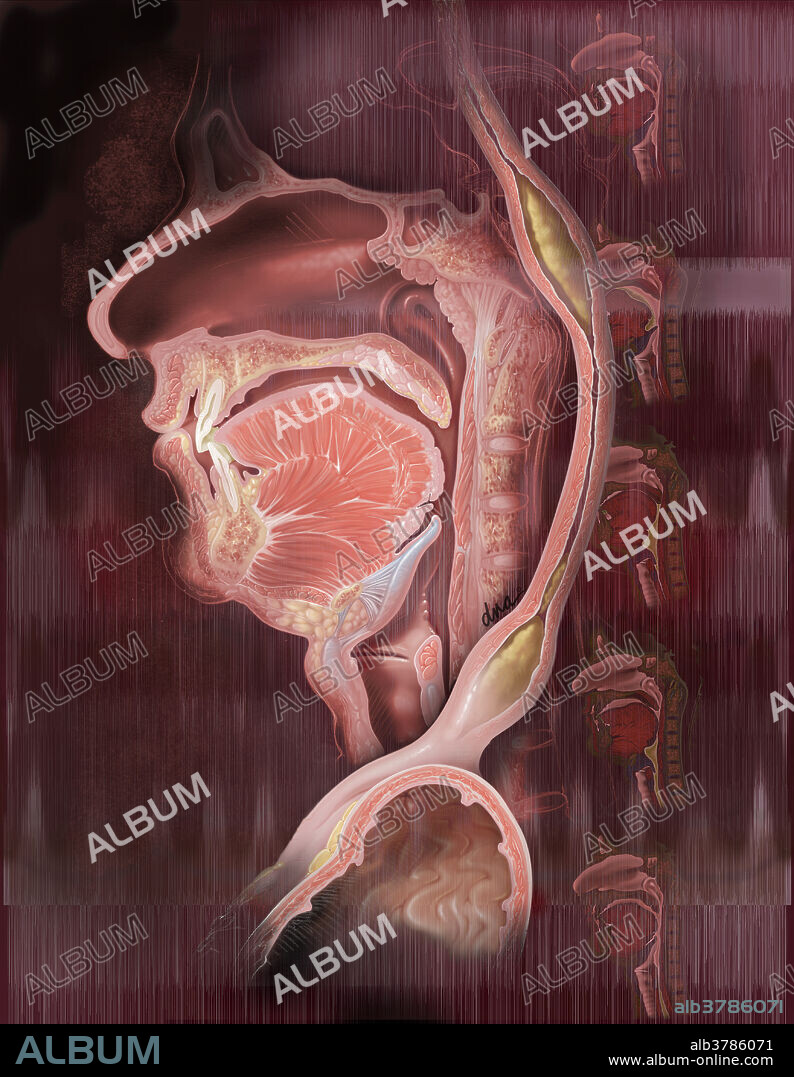 This illustration shows the principal anatomy of the swallowing apparatus plus the esophagus and stomach with peristaltic waves pushing a bolus towards the stomach in the esophageal phase. There are four phases involved in swallowing. The oral preparatory phase, the oral propulsive phase and the pharyngeal and esophageal phases. To the right are the steps in the pharyngeal phase of swallowing described in order from top to bottom.1. Principal anatomy involved in sagittal section2. Bolus moved to rear of oropharynx, and soft palate begins to elevate. The epiglottis moves to protect airway, while the vocal folds close at the midline. Hyoid bone elevates.3. Epiglottis has closed off larynx, and the soft palate has blocked food entry into the nasopharynx.