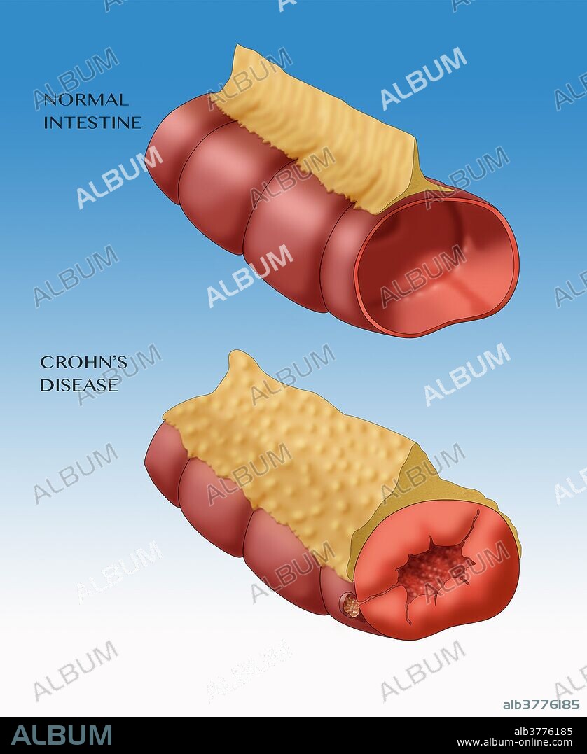 Normal Intestine (top) vs. Crohn's Disease in intestine (bottom) Illustration.