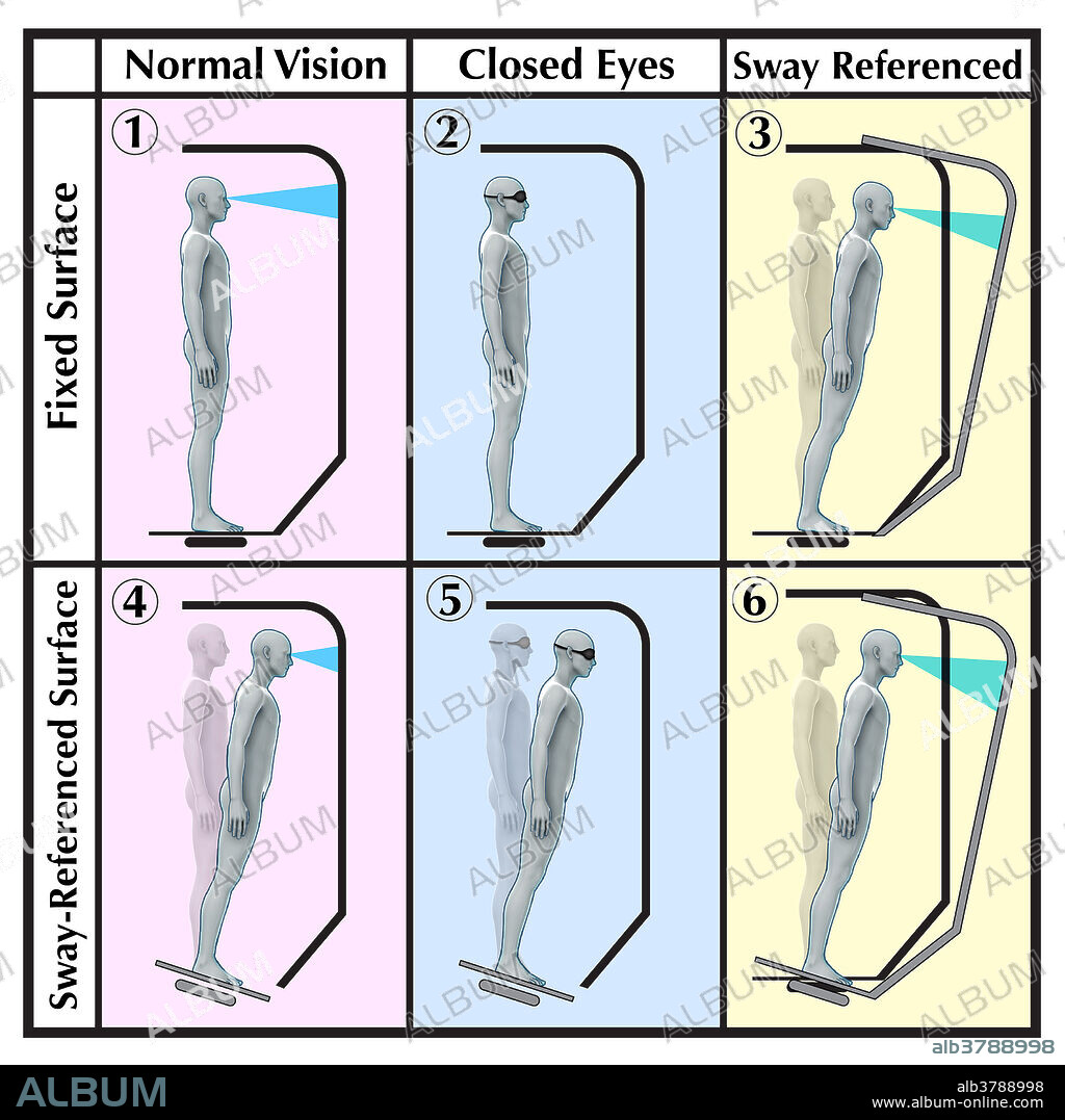 A sensory organization test assesses the ability to maintain balance and postural stability using different visual, somatosensory, and proprioceptive stimuli. During the test, the subject stands on a platform which is stationary or can move and sway (i.e. sway-referenced surface). Six conditions are replicated during the test to isolate stimuli that affect balance control and responses of the central nervous system.