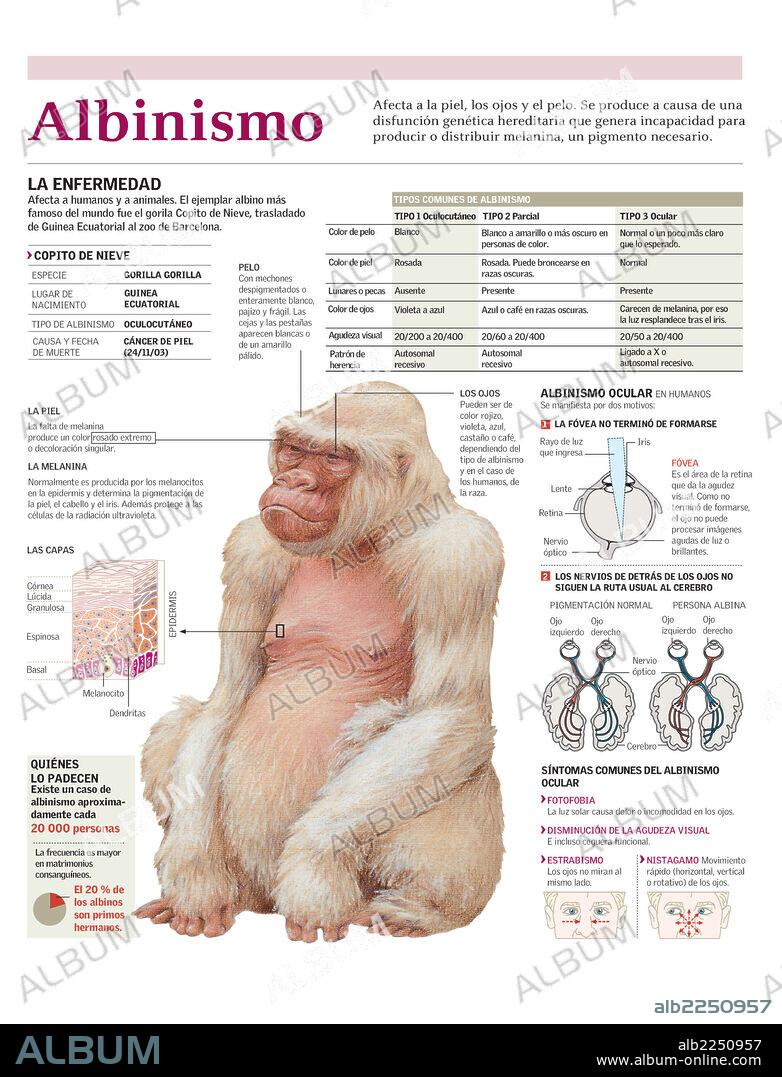 Albinism. Infographic on albinism, its different types and symptoms, featuring information on the albino gorilla named Snowflake.