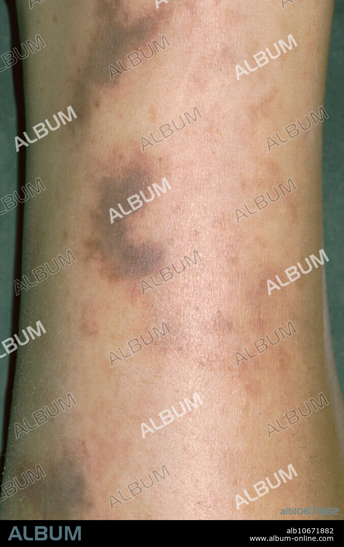 Meningococcal septicaemia. Meningococcal disease is caused by the bacterium Neisseria meningitidis, or meningococcus. It carries a high mortality rate if untreated but is a vaccine-preventable disease. While best known as a cause of meningitis, widespread blood infection can result in sepsis, which is a more damaging and dangerous condition. Meningitis and meningococcemia are major causes of illness, death, and disability in both developed and under-developed countries.