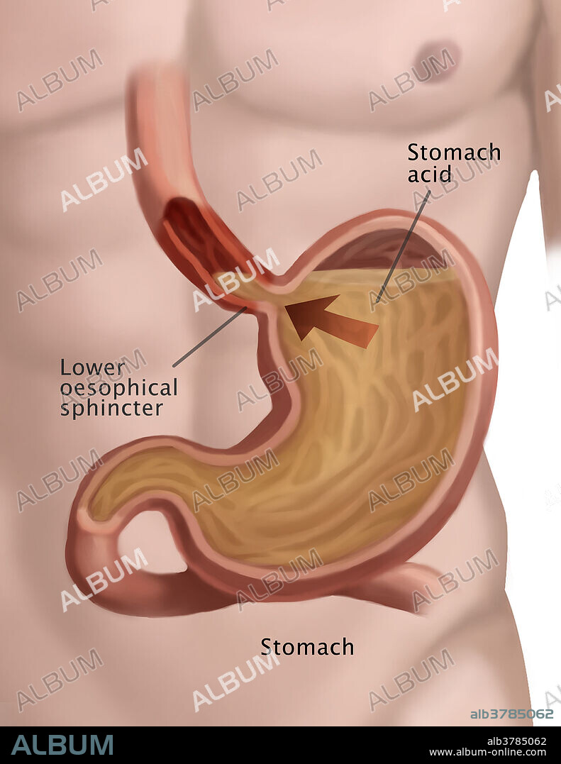 A medical illustration showing stomach acid reflux. Gastroesophageal reflux disease (GERD) occurs when food or liquid travels backwards from the stomach to the oesophagus.
