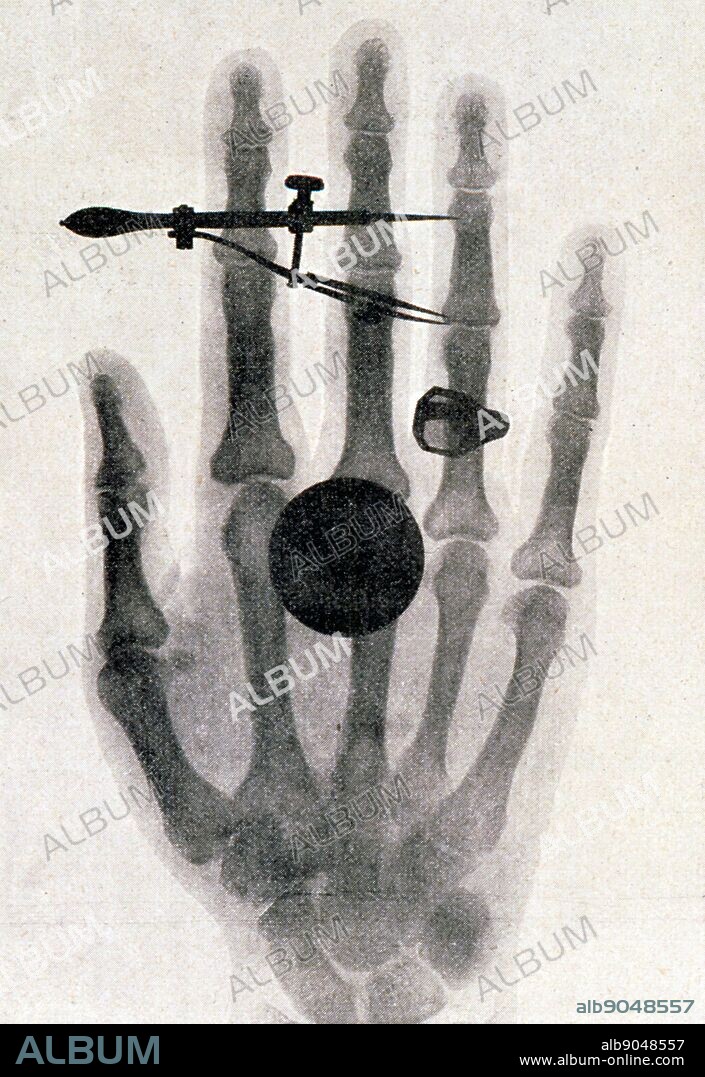 Wilhelm Roentgen's (1845-1923) X-ray photograph of his wife's hand: 1896. For his work on electromagnetic radiation and discovery of X-rays Roentgen awarded 1901 Nobel prize for Physics.