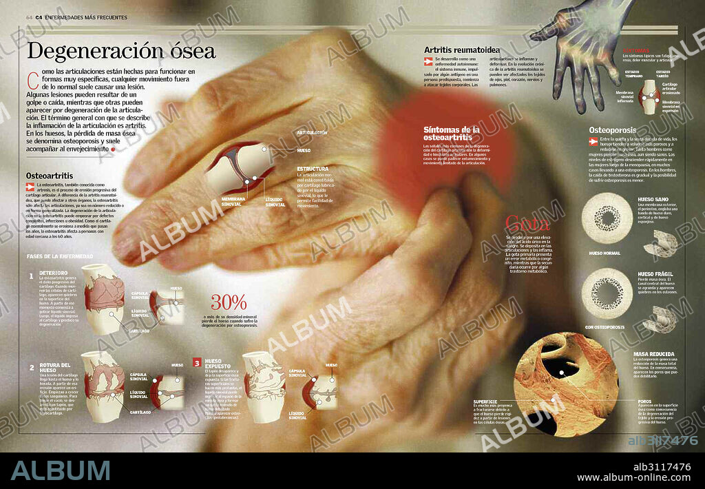 Degeneración ósea. Infografía dedicada a las principales enfermedades óseas: osteoartritis, artritis reumatoidea, osteoporosis y gota. Ilustra las fases de deterioro de la osteoratrtitis, ofrece la radiografía de una mano afectada de artritis reumatoidea, y muestra las secciones de un hueso sano y de otro afectado de osteoporosis.