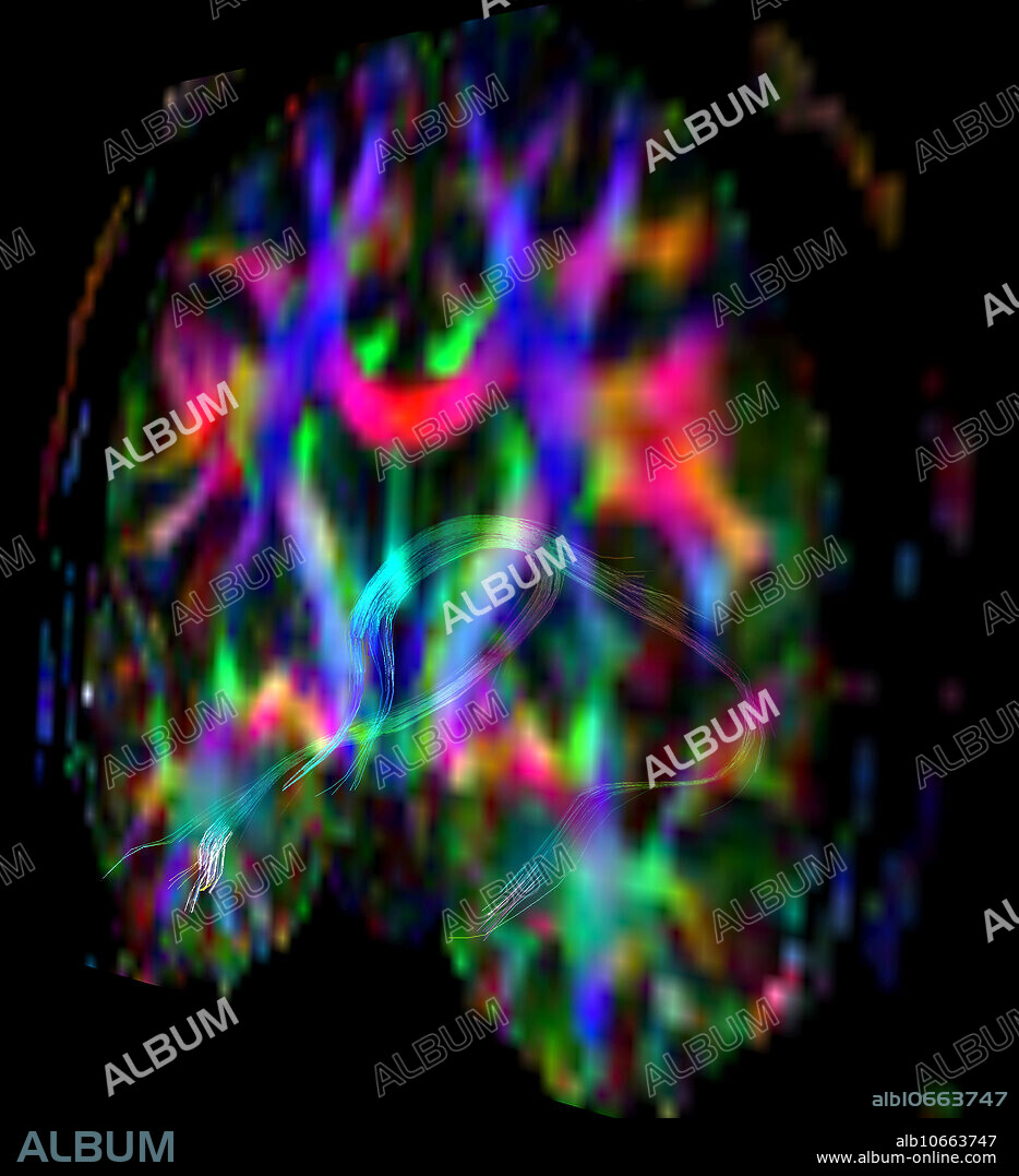 Fornix, hippocampus and mammillary body colour tractography. This oblique (angled) coronal (frontal) plane colour DTI image provides information and depiction of the major white matter tracts in the brain. By convention tracts oriented from anterior to posterior (front to back) are green, tracts oriented from side to side are red and those tracts oriented superior to inferior (head to toe) are blue. fxc = columns of fornix, fxb = body of fornix, fxcr = crura of fornix, mb = mammillary body, ac = anterior commissure, cc = corpus callosum.