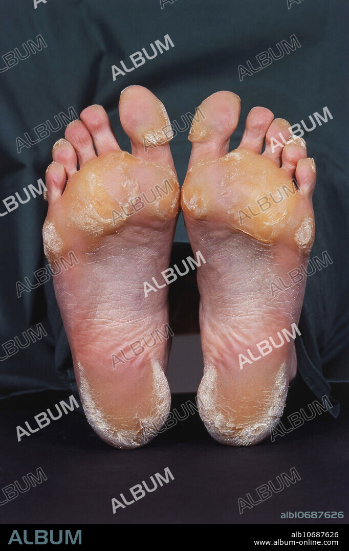 Tylosis, also known as Diffuse Nonepidermolytic Palmoplantar Keratoderma. This inherited autosomal dominant condition is characterized by a well-demarcated, symmetric, often waxy keratoderma involving the entire sole of the foot.