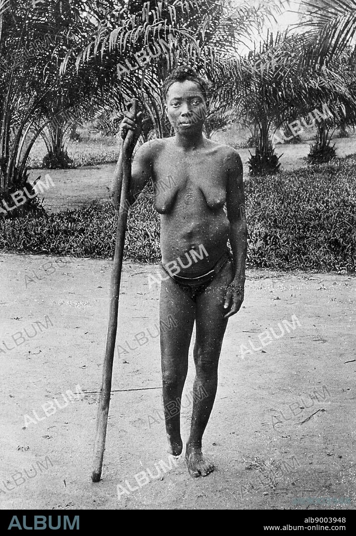 Amputation was frequently used to punish workers in the Congo Free State; controlled by Leopold II of Belgium 1900.